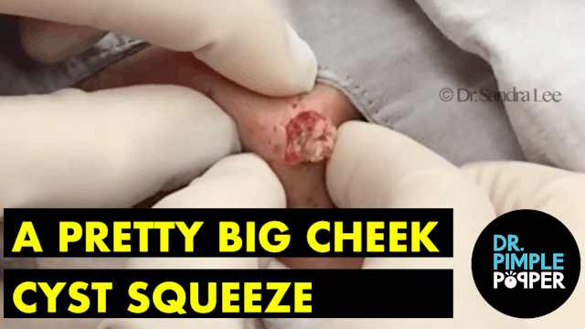 A pretty. BIG cheek cyst SQUEEZE