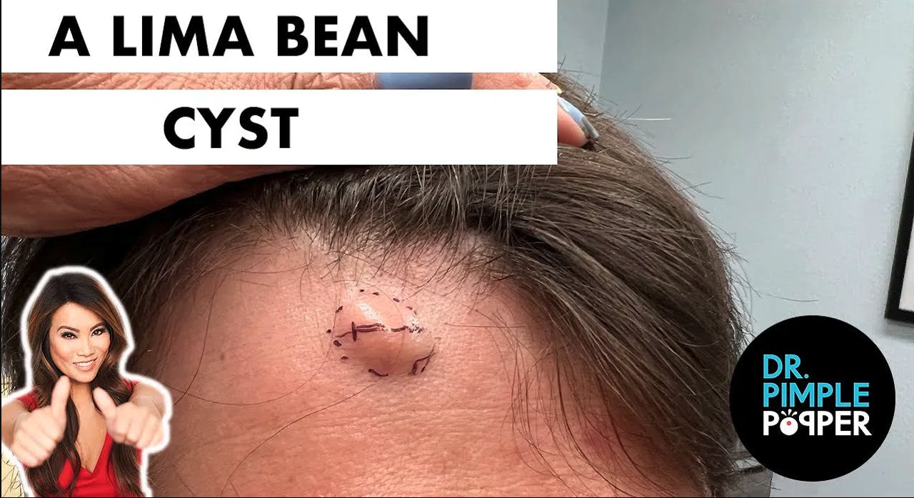 A Lima Bean Cyst Cystactular Cysts Dr. Pimple Popper