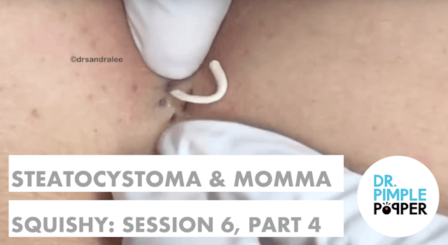 Steatocystomas & Momma Squishy: Session 6 Part 3