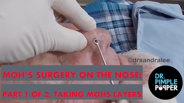 Mohs Sugery On The Nose: Part 1