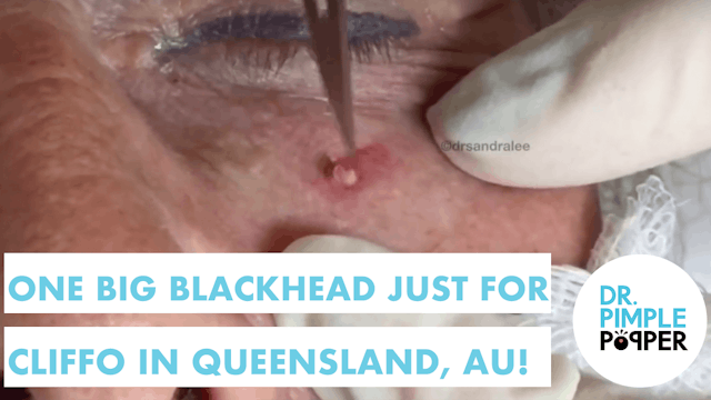 One Blackhead Just for Cliffo in Quee...
