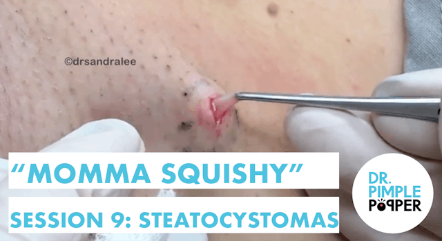 We are so THANKFUL for Momma Squishy & Steatocystomas: Session 9