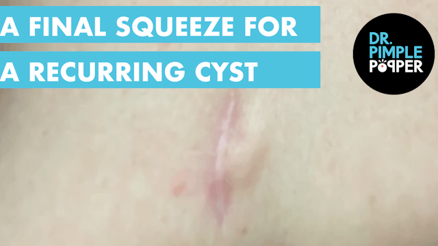 A Final Squeeze For A Recurring Cyst