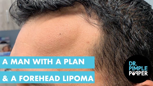 A Man with a Plan & a Forehead Lipoma