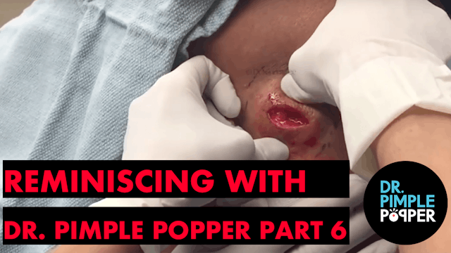 Reminiscing with Dr Pimple Popper, TB...