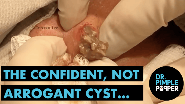 The Confident, Not Arrogant Cyst...