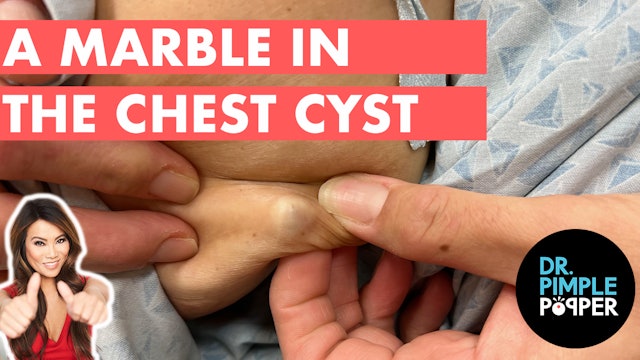 A Marble in the Chest Cyst