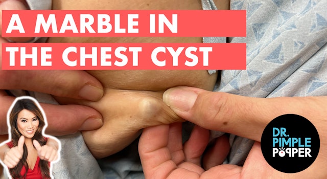 A Marble in the Chest Cyst