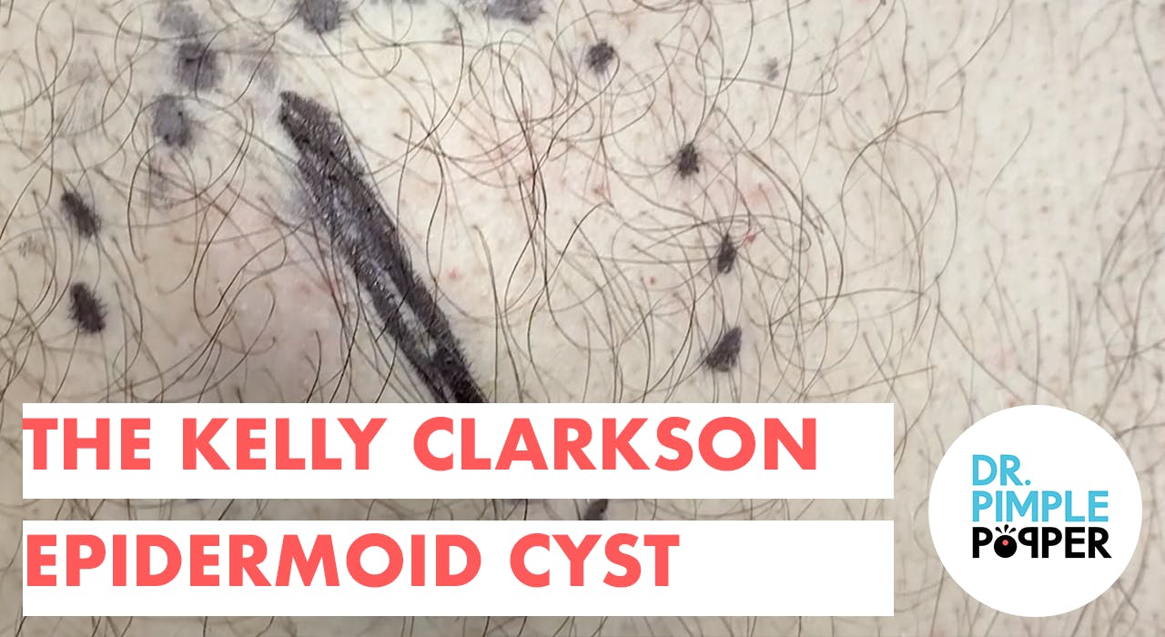The Kelly Clarkson Epidermoid Cyst on the Chest Dr. Pimple Popper