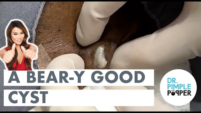 A Bear-y Good Cheek Cyst