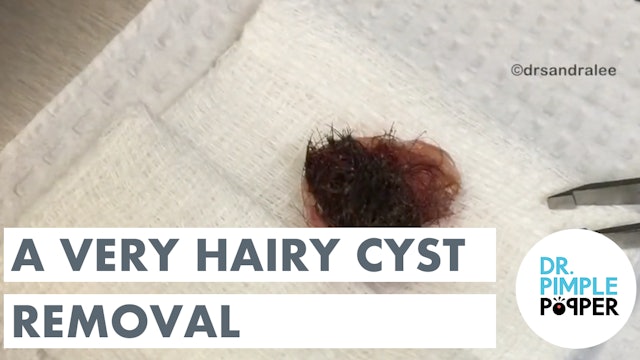A Very HAIRY Removal on THIS Scalp Cyst!