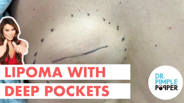 Lipoma with Deep Pockets