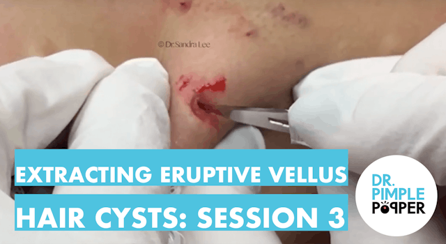 Extracting Eruptive Vellus Hair Cysts...