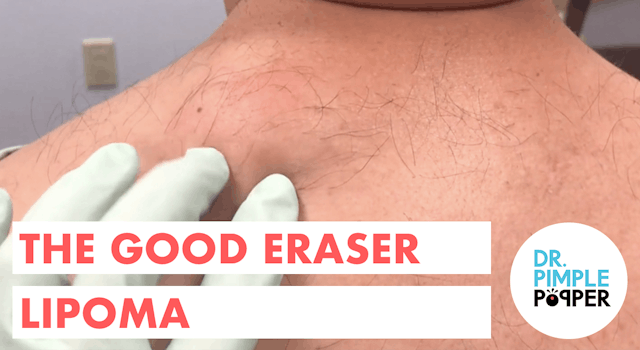 The Good Eraser Lipoma 