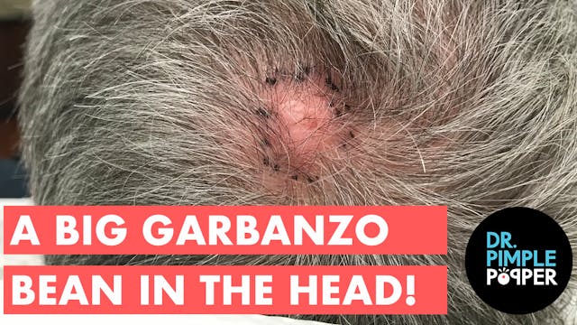 A Big Garbanzo Bean in the Head!