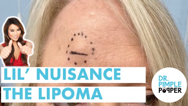 Lil' Nuisance the Lipoma