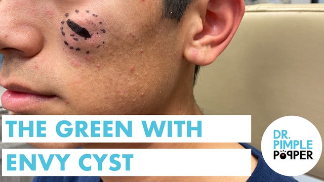 The Green With Envy Epidermoid Cyst