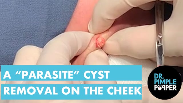 A "Parasite" Cyst Removal