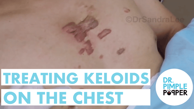 Using My GoPro: Treating Keloids with IL Steroids and V Beam