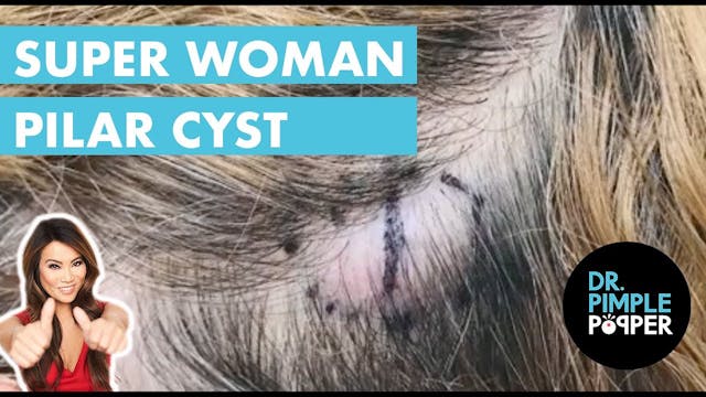 A Super Woman Pilar Cyst 