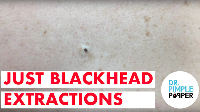 Just Blackhead Extractions