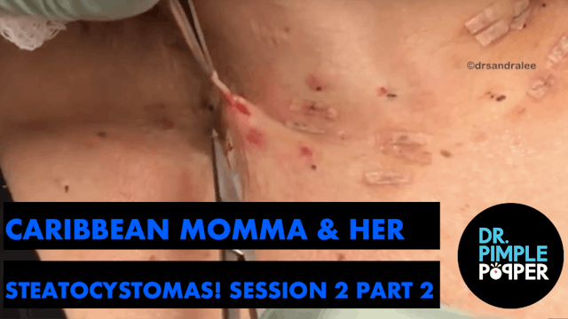 Caribbean Momma's Steatocystomas! Session Two, Part Two