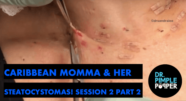 Caribbean Momma's Steatocystomas! Session Two, Part Two