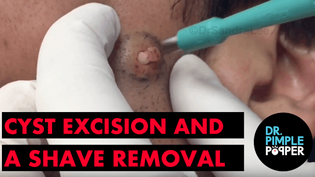 A Cyst Excision and A Shave Removal