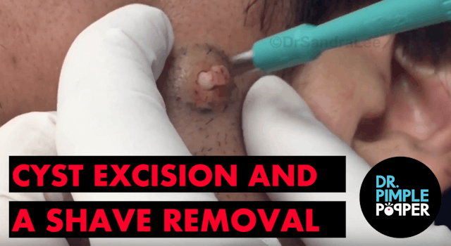 A Cyst Excision and A Shave Removal