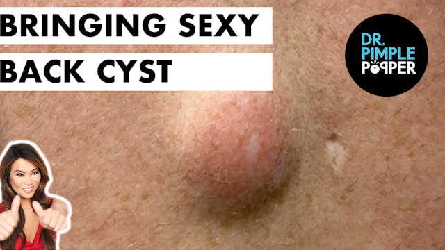 Bringing Sexy Back Cyst
