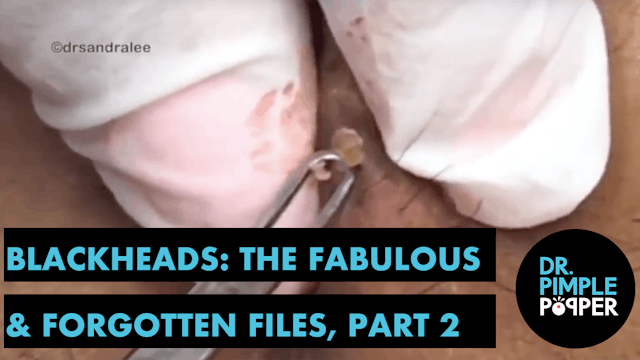 Blackheads: The Fabulous & Forgotten, Part Two (Ft. Pimple Pete!)