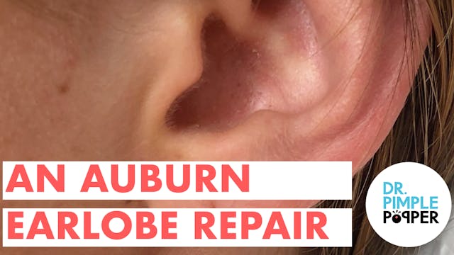 An Auburn Earlobe Repair