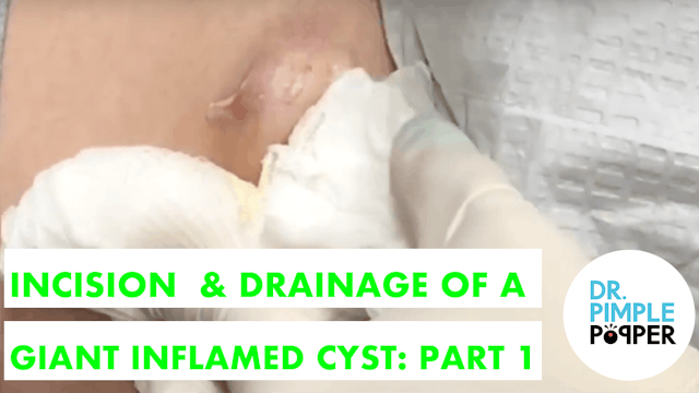 Inflamed Egg-Shaped Cyst Removed, Rig...