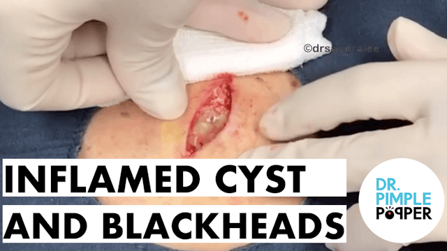 Inflamed Cyst and Back Blackheads aka Favre Racouchot