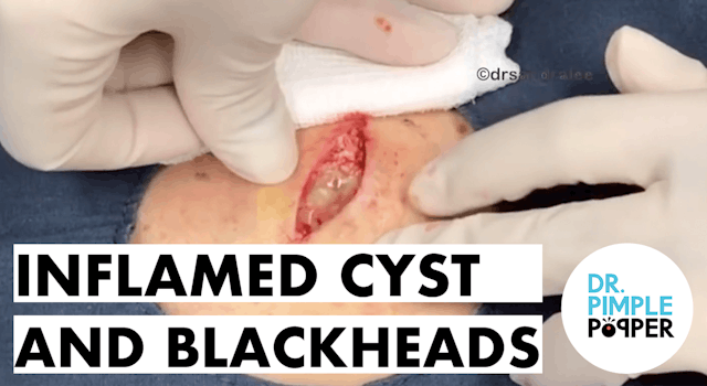 Inflamed Cyst and Back Blackheads aka...