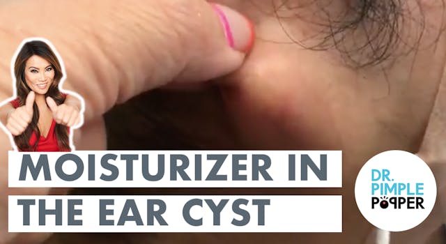 Moisturizer In The Ear Cyst