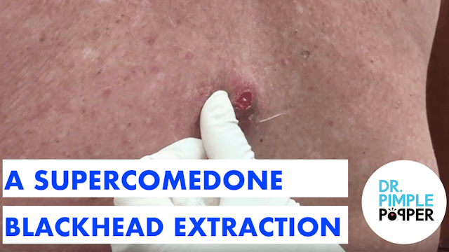 A SuperComedone Blackhead Extraction ...