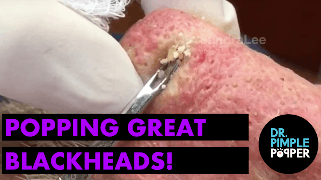Popping GREAT blackheads after Mohs skin cancer surgery