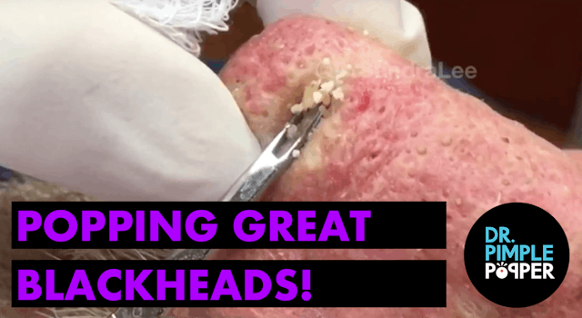 Popping GREAT blackheads after Mohs s...