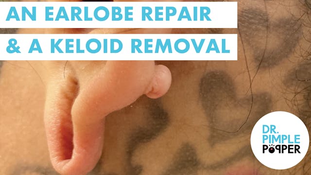 An Earlobe Repair & A Keloid Removal