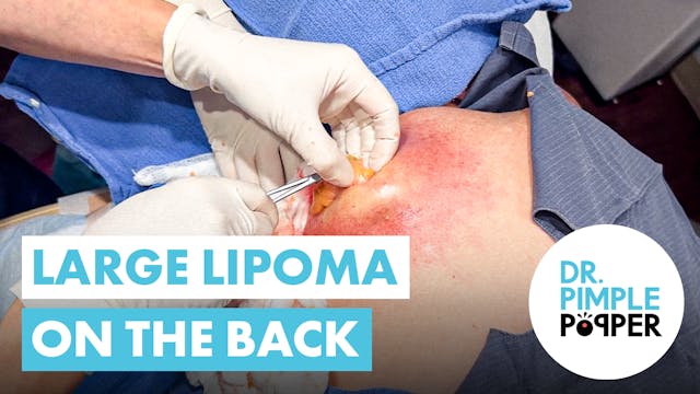 Large Lipoma on the Back