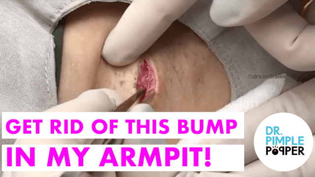 Get Rid of the Bump in my Armpit!!