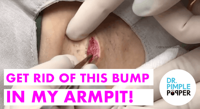 Get Rid of the Bump in my Armpit!!