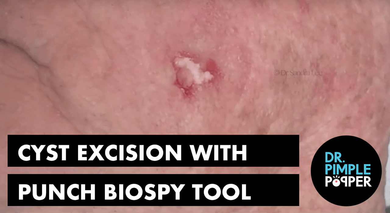 Featured image of post Steps to Make Punch Biopsy Tool Cyst