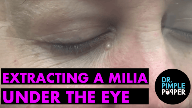 Extracting Milia Under the Eye