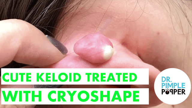 A Cute Keloid Treated with Cryoshape