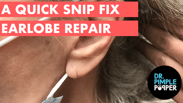 A Quick Snip Fix Earlobe Repair