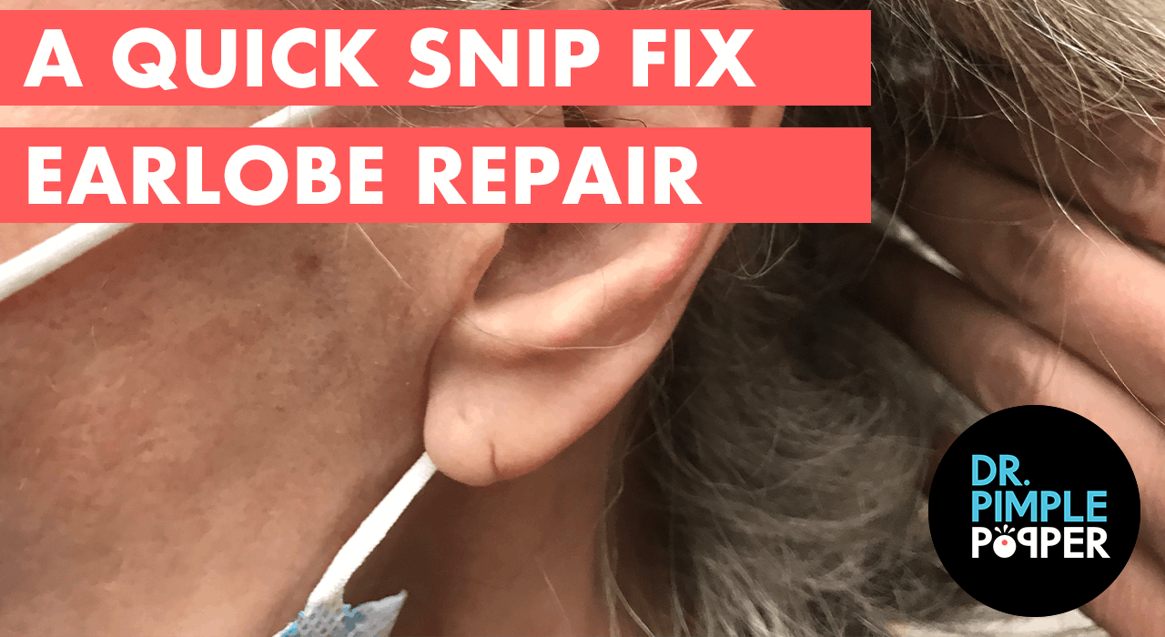 A Quick Snip Fix Earlobe Repair Dr. Pimple Popper