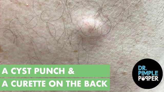 A Cyst Punch & Curette on the Back 