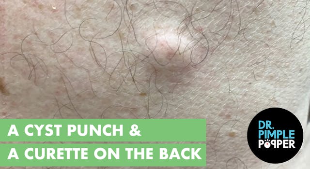 A Cyst Punch & Curette on the Back 